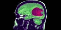 A New approach could help Treat Severe Brain Tumors