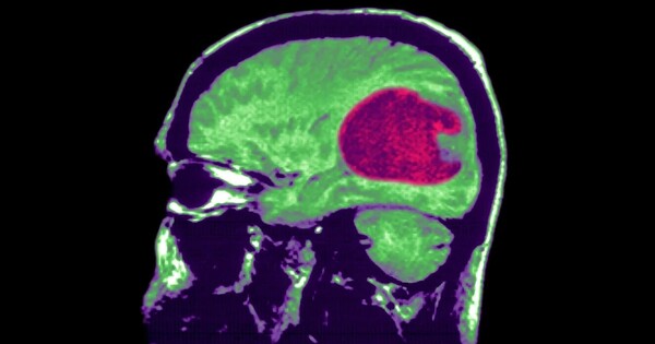 A New approach could help Treat Severe Brain Tumors