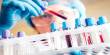 Blood Tests may Help Guide the use of Multiple Myeloma Immunotherapy