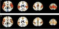 Researchers identify Brain connections associated with ADHD in Youth