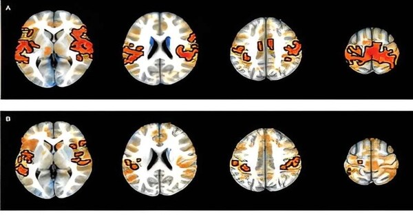 Researchers identify Brain connections associated with ADHD in Youth