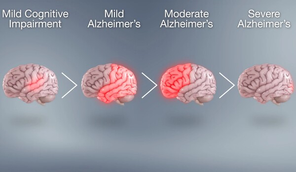 Cancer drug could treat early-stage Alzheimer's disease, study shows