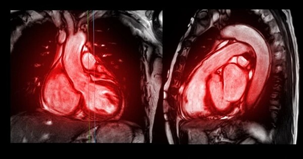 Breakthrough heart MRI technique accurately predicts heart failure risk in general population