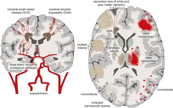 Brain vasculature changes important for predicting cognitive impairment