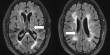 Changes in Brain Vasculature are critical in predicting Cognitive Decline