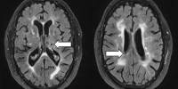 Changes in Brain Vasculature are critical in predicting Cognitive Decline