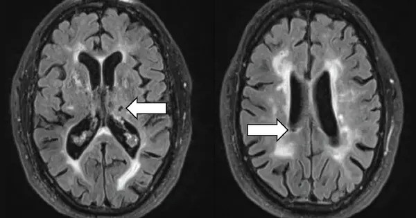 Changes in Brain Vasculature are critical in predicting Cognitive Decline