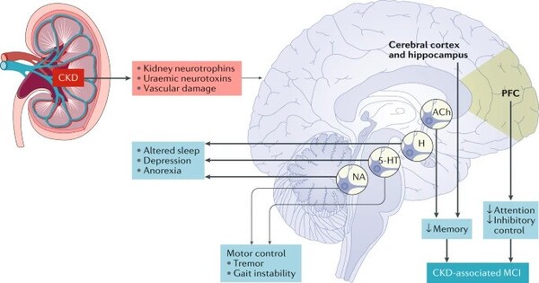 Cognitive Dysfunction in Chronic Kidney Disease