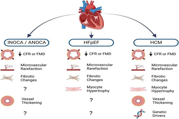 Gene-related metabolic dysfunction may be driving heart arrhythmia