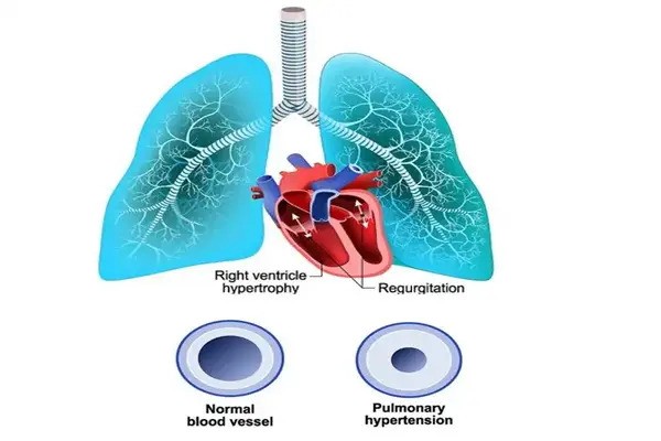 New insights and potential treatments for pulmonary hypertension