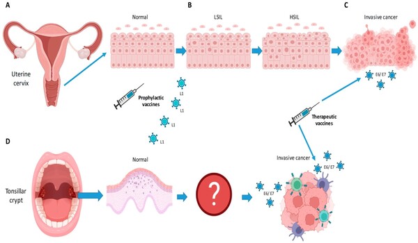 New vaccine against cervical cancer combines prophylactic and therapeutic activity