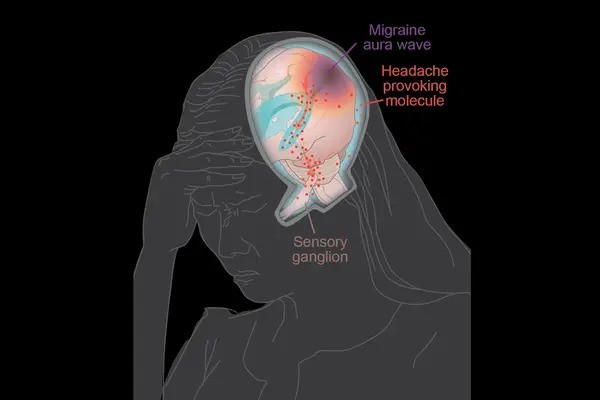 Brain fluid dynamics key to migraine mysteries, new therapies