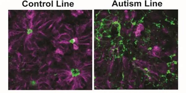 Neurons look different in children with autism, research finds