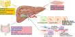 A New Technique to Treating Fatty Liver Disease