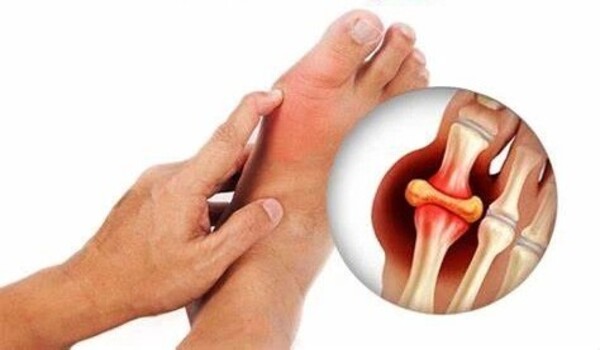 Study busts myths about cause of gout