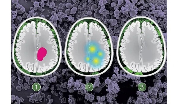 Implantable microparticles can deliver two cancer therapies at once