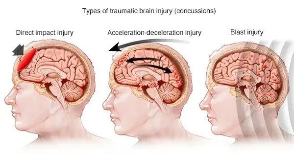 Early Rehabilitation improves the Results of Concussions