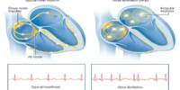 Research Shows Anticoagulant Medications decreased Bleeding incidents in Atrial Fibrillation Patients