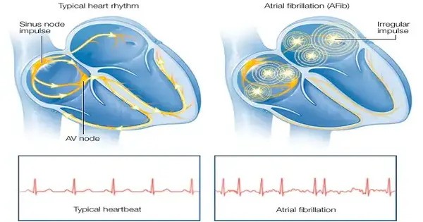 Research Shows Anticoagulant Medications decreased Bleeding incidents in Atrial Fibrillation Patients