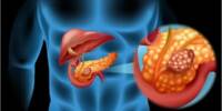 Biologists find targets for novel therapy for Pancreatic Cancer
