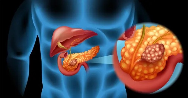 Biologists find targets for novel therapy for Pancreatic Cancer