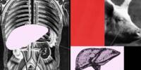 Researchers use a genetically modified Pig Liver to keep a Human Alive