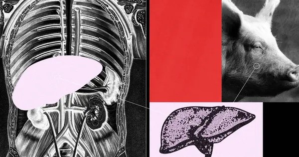 Researchers use a genetically modified Pig Liver to keep a Human Alive
